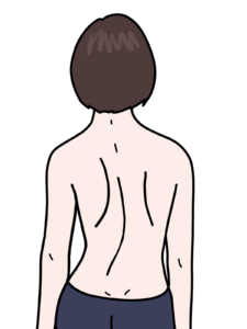 背部から見た側弯症